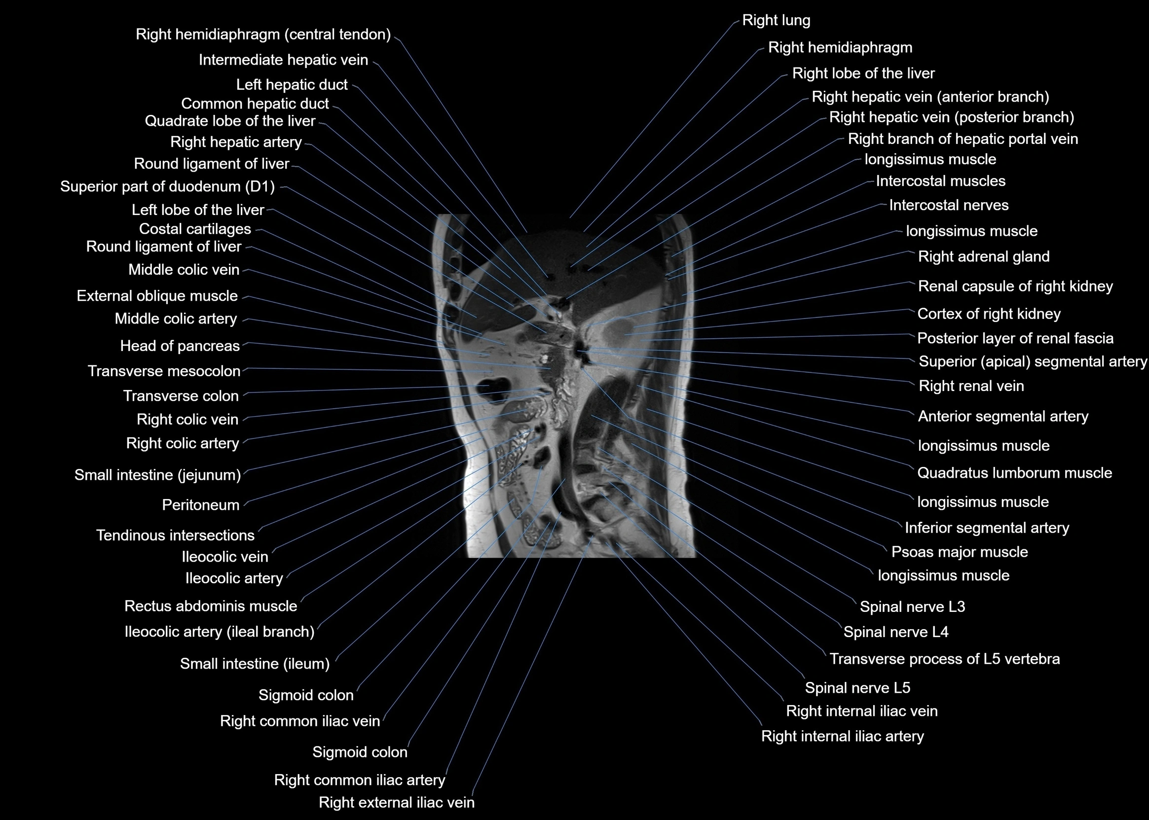 MRI abdomen sagittal cross sectional anatomy  radiology  image-img-00001-00030.webp